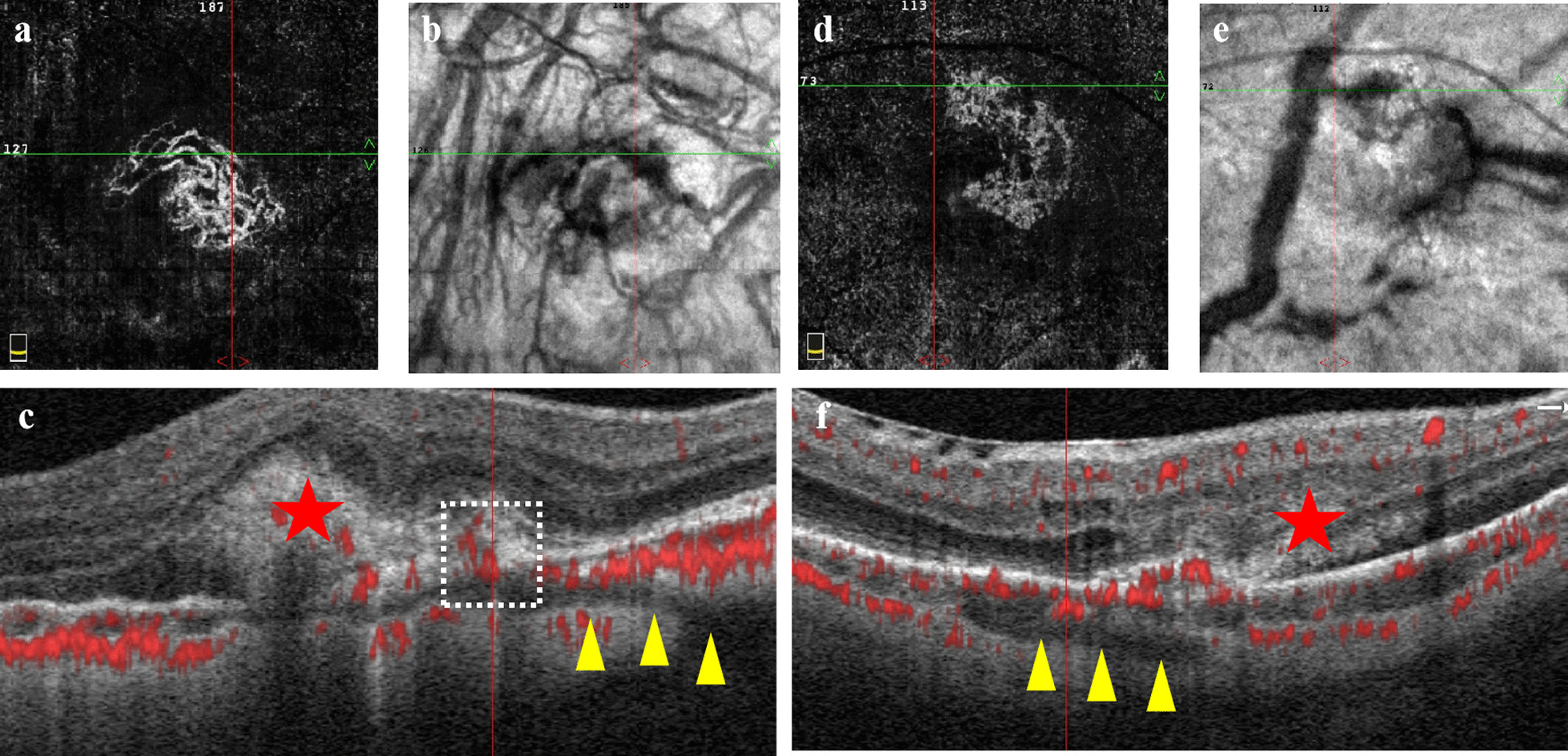Myopic choroidal neovascularization with neovascular signal around perforating scleral vessel prone to recur after anti-VEGF therapy.