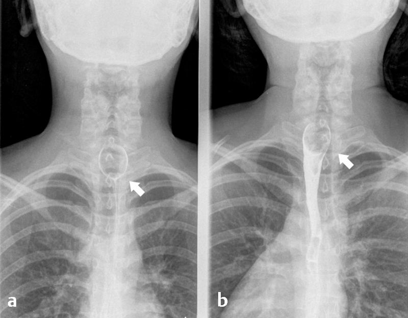 Esophageal Leiomyoma: Case Report.