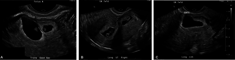 Spontaneous Heterotopic Cesarean Scar Triplet Gestation Following Uterine Ablation.