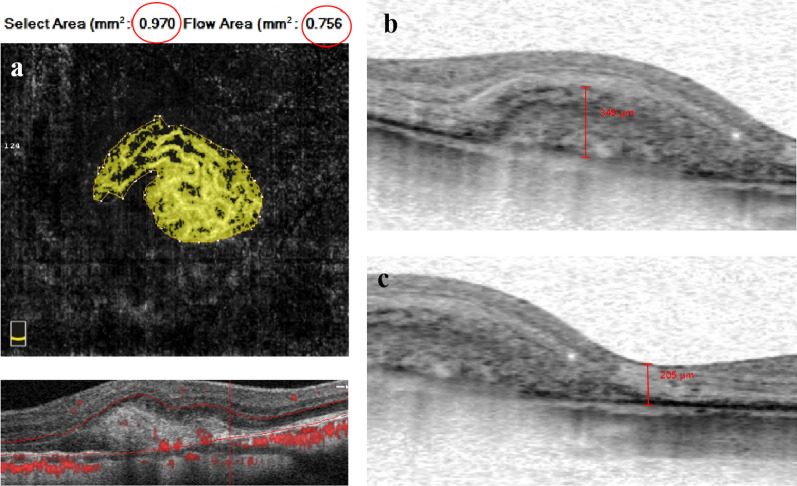 Myopic choroidal neovascularization with neovascular signal around perforating scleral vessel prone to recur after anti-VEGF therapy.