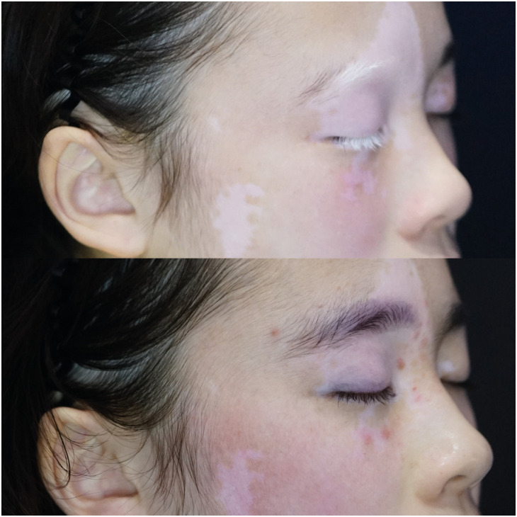 Eyelash Dyeing for Poliosis of Eyelashes in Patients With Vitiligo.