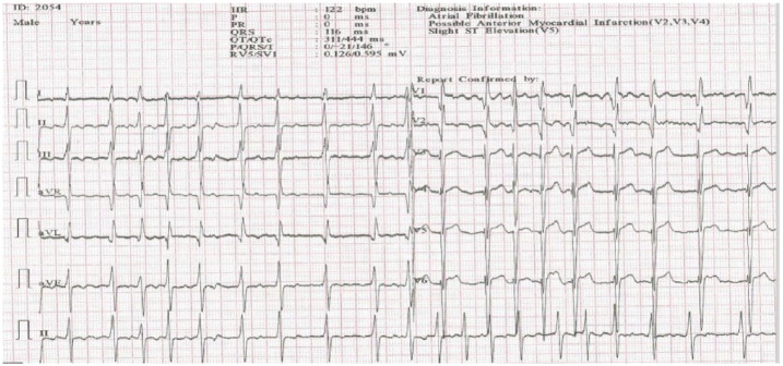 Severe Pulmonary Hypertension From Combined Ventricular Septal Defect and Rheumatic MIitral Valve Disease: A Case Report and Literature Review.