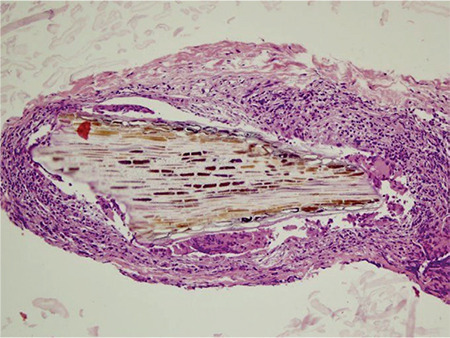 Embedded Episcleral Foreign Body Mimicking Nodular Anterior Scleritis.