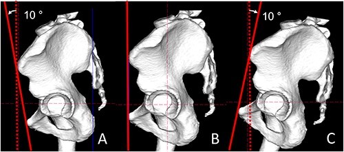Multivariate linear-mixed analysis of changes in anterior inferior iliac spine impingement incidence with posterior pelvic tilt: a computer simulation study.