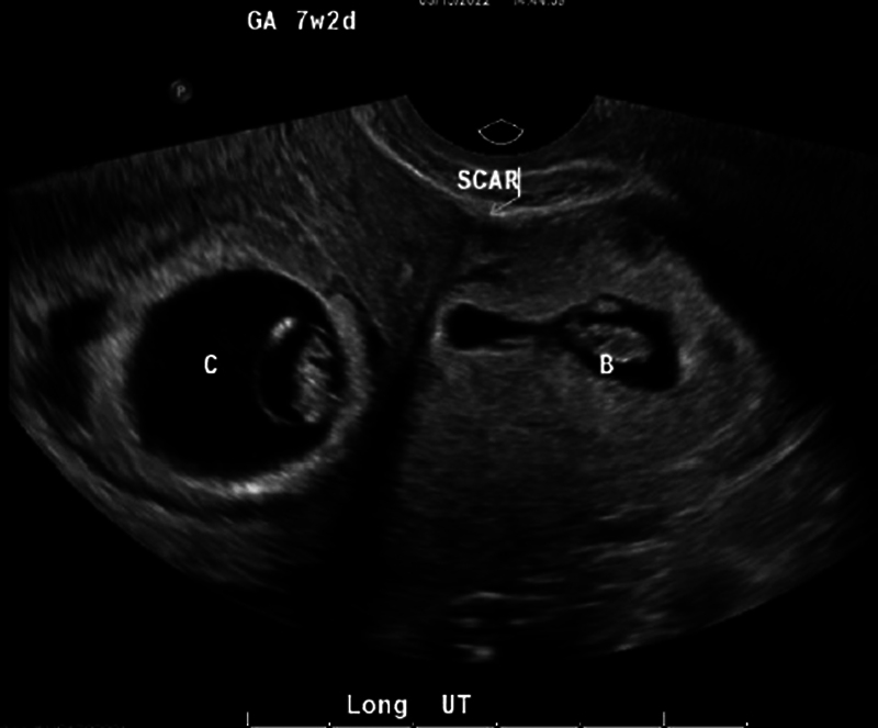 Spontaneous Heterotopic Cesarean Scar Triplet Gestation Following Uterine Ablation.