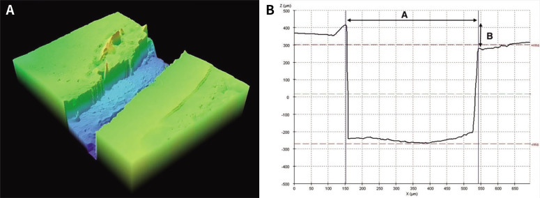 Clinical comparison of marginal fit of ceramic inlays between digital and conventional impressions.