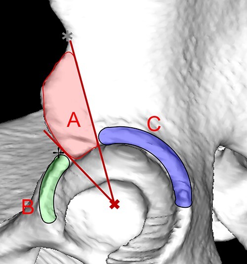 Multivariate linear-mixed analysis of changes in anterior inferior iliac spine impingement incidence with posterior pelvic tilt: a computer simulation study.