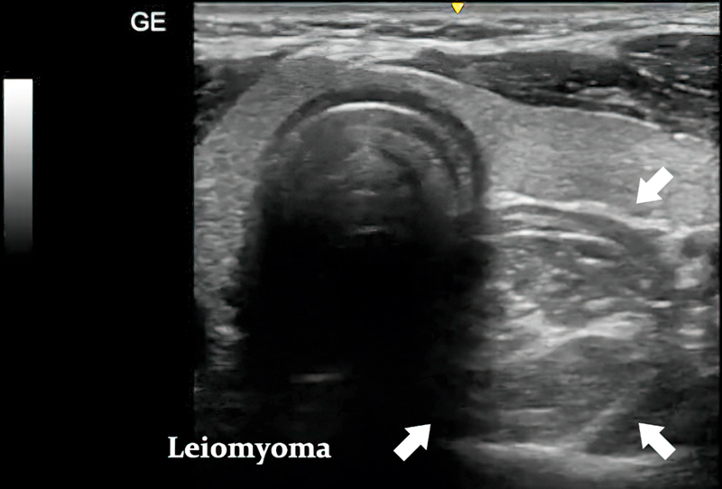 Esophageal Leiomyoma: Case Report.