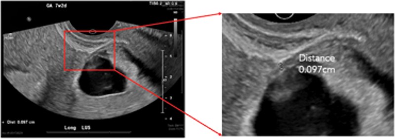 Spontaneous Heterotopic Cesarean Scar Triplet Gestation Following Uterine Ablation.