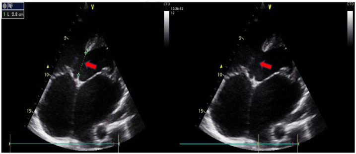 Severe Pulmonary Hypertension From Combined Ventricular Septal Defect and Rheumatic MIitral Valve Disease: A Case Report and Literature Review.