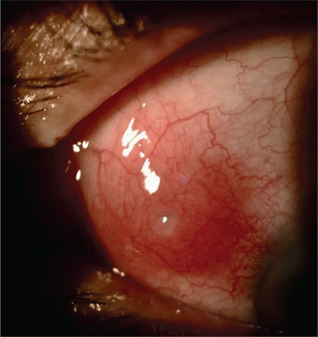Embedded Episcleral Foreign Body Mimicking Nodular Anterior Scleritis.