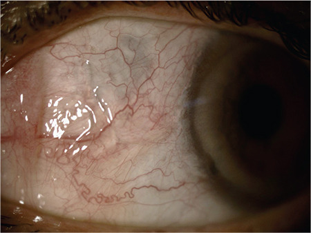 Embedded Episcleral Foreign Body Mimicking Nodular Anterior Scleritis.