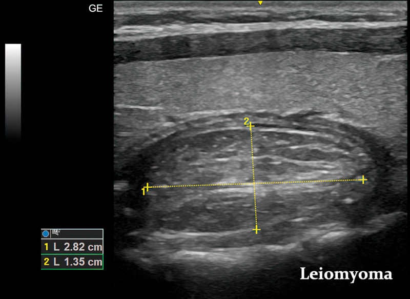 Esophageal Leiomyoma: Case Report.