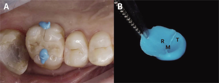 Clinical comparison of marginal fit of ceramic inlays between digital and conventional impressions.