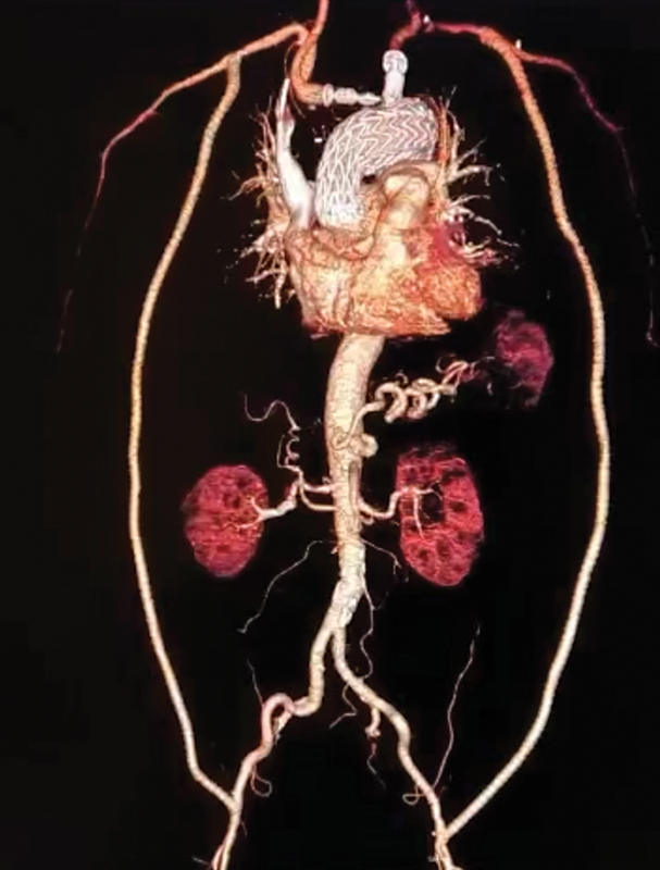Hybrid Treatment of Complex Para-anastomotic Aortic Arch Pseudoaneurysm.