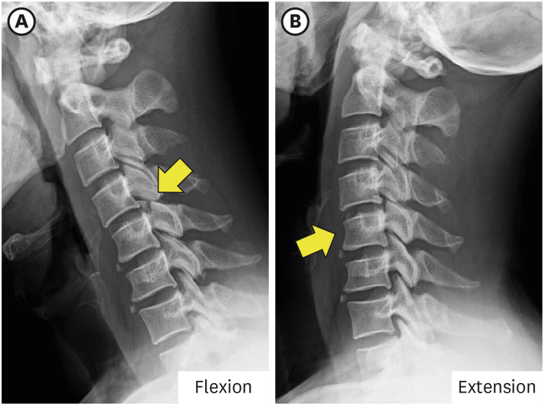 Delayed Unilateral Facet Interlocking After a Stable Superior Articular Process Fracture of the Cervical Spine: A Case Report.