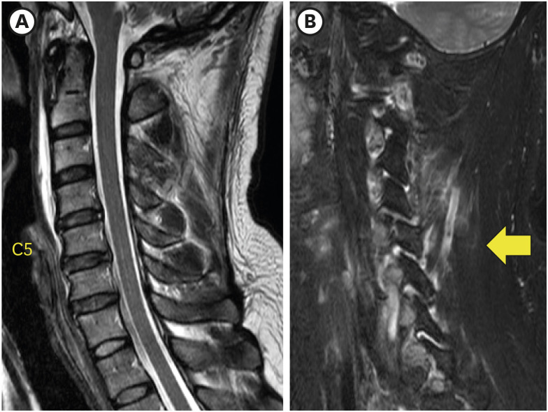Delayed Unilateral Facet Interlocking After a Stable Superior Articular Process Fracture of the Cervical Spine: A Case Report.