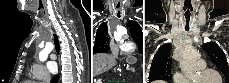 Hybrid Treatment of Complex Para-anastomotic Aortic Arch Pseudoaneurysm.