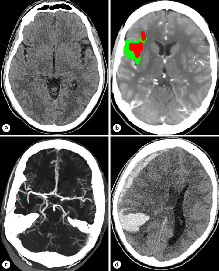 Disseminated Aspergillosis with Mediastinal Invasion Causing Fatal Stroke in an Immunocompetent Young Man.