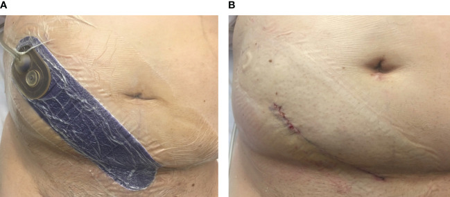 Prospective evaluation of a closed-incision negative pressure wound therapy system in kidney transplantation and its association with wound complications.
