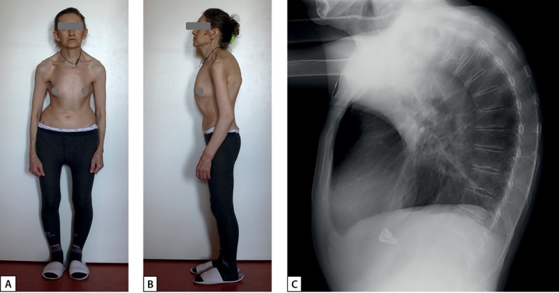[Hyperparathyroidism of different genesis in young patients with Turner syndrome: case series and brief review].