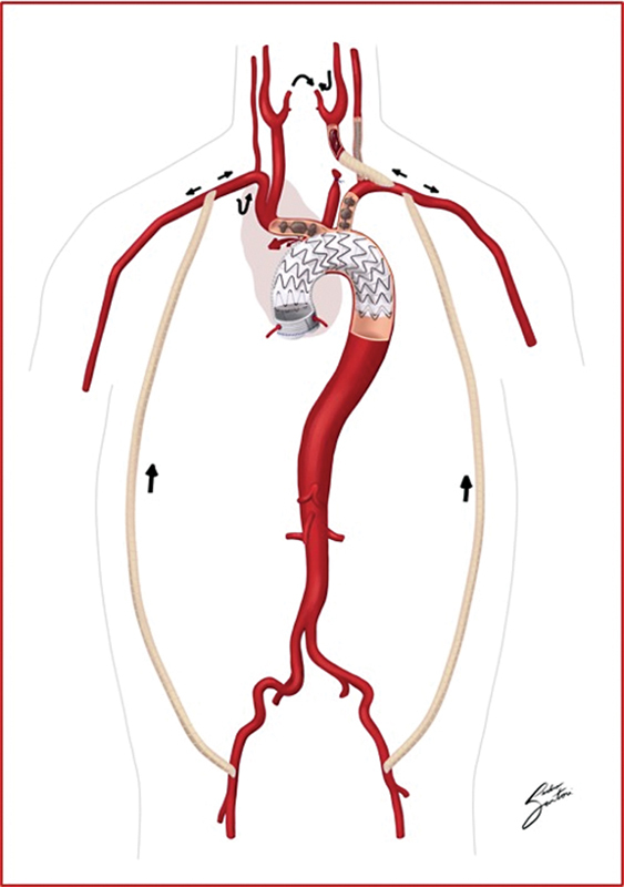 Hybrid Treatment of Complex Para-anastomotic Aortic Arch Pseudoaneurysm.