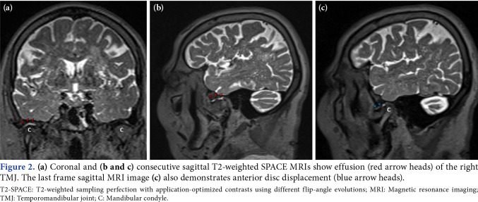 Investigation of incidental findings of temporomandibular joint disorders on brain magnetic resonance imaging in three-dimensional T2-weighted SPACE sequence performed for brain imaging.