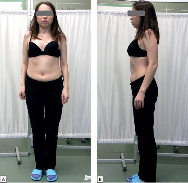 [Hyperparathyroidism of different genesis in young patients with Turner syndrome: case series and brief review].
