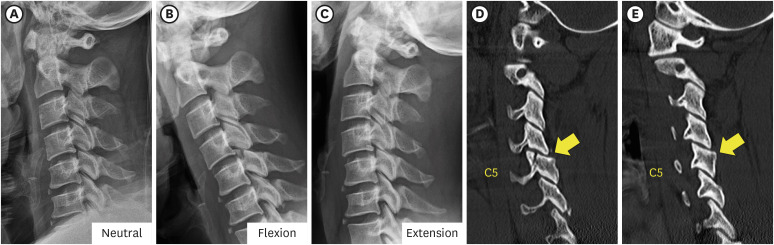 Delayed Unilateral Facet Interlocking After a Stable Superior Articular Process Fracture of the Cervical Spine: A Case Report.