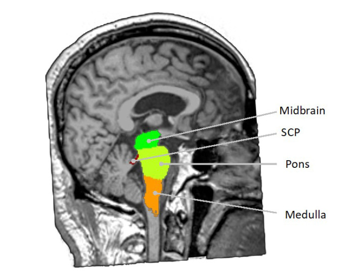 Exploring Brainstem Structural Abnormalities: Potential Biomarkers for Panic Disorder.