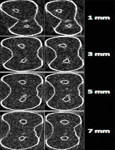 Evaluation of apical transportation and centering ability of three single-file systems in severely curved canals using micro-computed tomography.