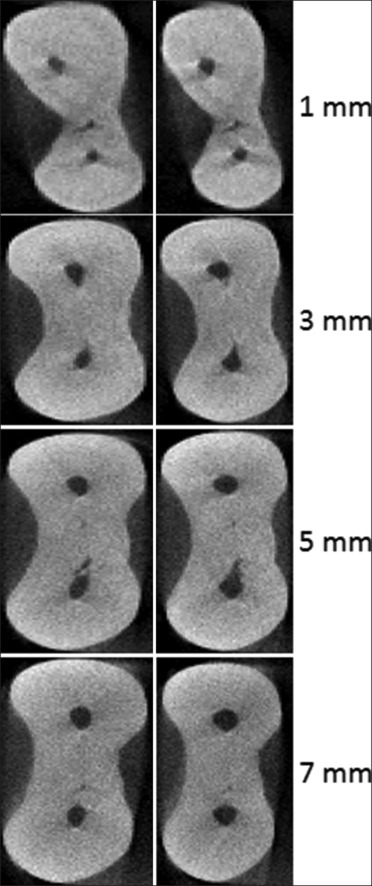 Evaluation of apical transportation and centering ability of three single-file systems in severely curved canals using micro-computed tomography.