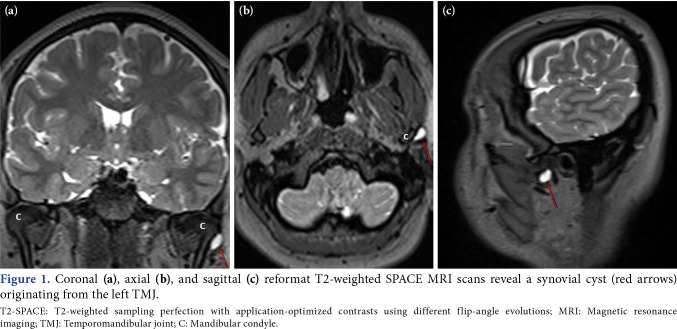 Investigation of incidental findings of temporomandibular joint disorders on brain magnetic resonance imaging in three-dimensional T2-weighted SPACE sequence performed for brain imaging.