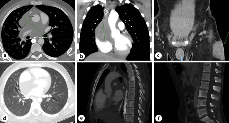 Disseminated Aspergillosis with Mediastinal Invasion Causing Fatal Stroke in an Immunocompetent Young Man.