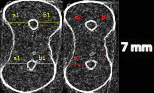 Evaluation of apical transportation and centering ability of three single-file systems in severely curved canals using micro-computed tomography.