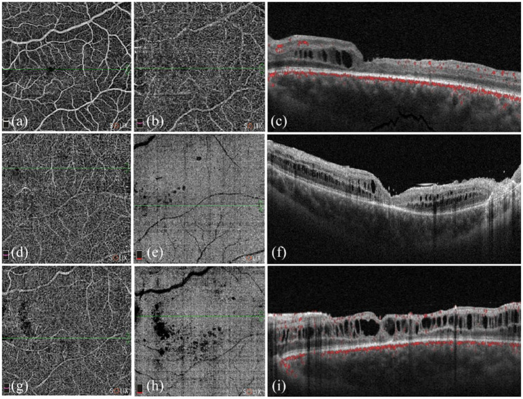 Early recurrence of macular schisis in X-linked retinoschisis treated with vitrectomy for rhegmatogenous retinal detachment under silicone oil: case report and brief literature review.