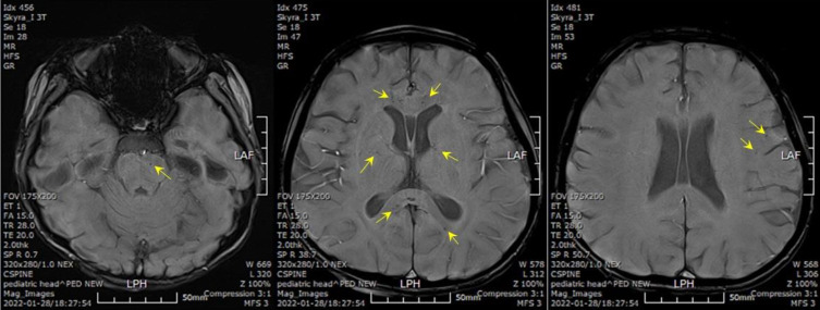 The first case of hyperosmolar diabetic ketoacidosis in a patient diagnosed with MODY 5 (maturity-onset diabetes of the young type 5) and 17q12 microdeletion syndrome.
