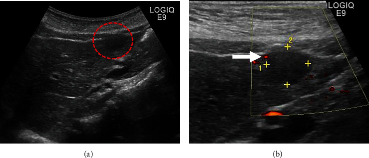 Reactive Lymphoid Hyperplasia of the Liver Incidentally Found in a 55-Year-Old Woman with a History of Ulcerative Colitis.