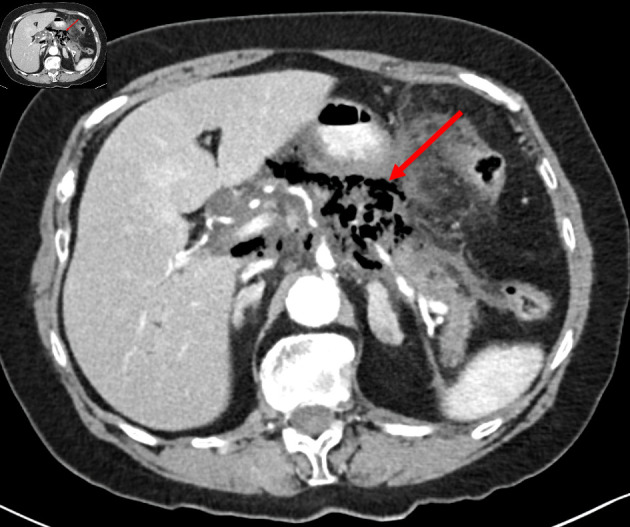 Fulminant Emphysematous Pancreatitis: Diagnosis Time Counts.