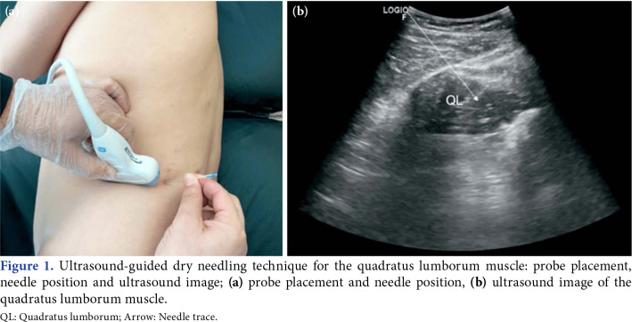 Ultrasound-guided dry needling for chronic low back pain: A case report targeting the quadratus lumborum muscle.