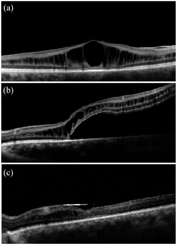 Early recurrence of macular schisis in X-linked retinoschisis treated with vitrectomy for rhegmatogenous retinal detachment under silicone oil: case report and brief literature review.