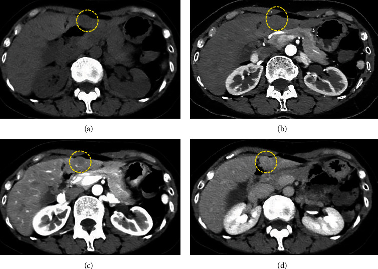 Reactive Lymphoid Hyperplasia of the Liver Incidentally Found in a 55-Year-Old Woman with a History of Ulcerative Colitis.