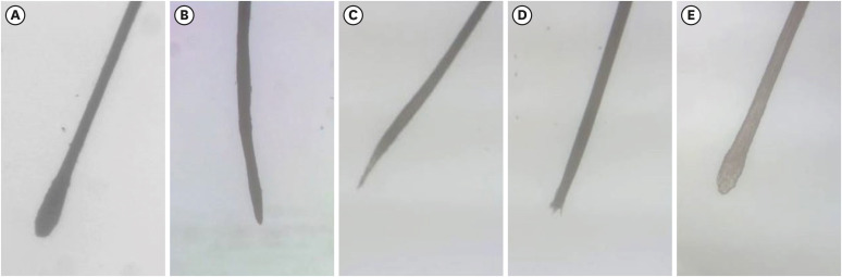 The Ratio of Typical Clubbing in Pulled-Out Hairs as a Useful Marker in Predicting the Course of Alopecia Areata.