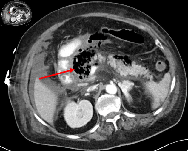 Fulminant Emphysematous Pancreatitis: Diagnosis Time Counts.