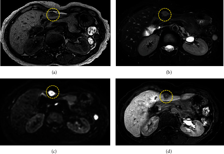 Reactive Lymphoid Hyperplasia of the Liver Incidentally Found in a 55-Year-Old Woman with a History of Ulcerative Colitis.