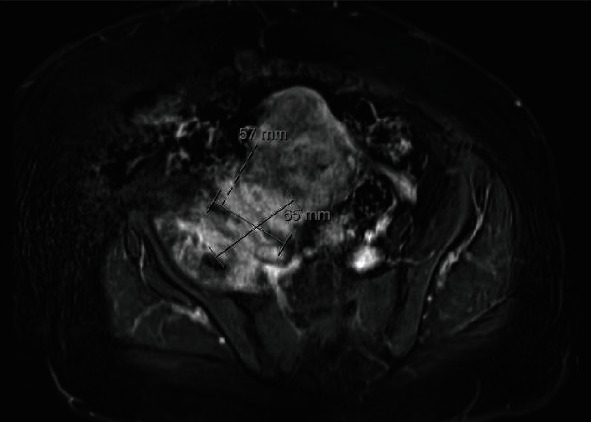 Conservative Treatment of an Unusual Presentation of Iliopsoas Phlegmon Related to Infected Intrauterine Contraceptive Device.