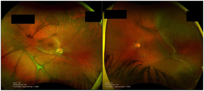 Early recurrence of macular schisis in X-linked retinoschisis treated with vitrectomy for rhegmatogenous retinal detachment under silicone oil: case report and brief literature review.
