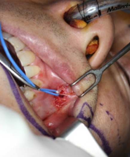 Facial palsy reconstruction.