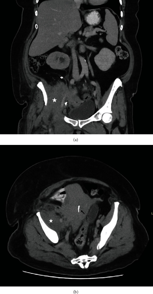 Conservative Treatment of an Unusual Presentation of Iliopsoas Phlegmon Related to Infected Intrauterine Contraceptive Device.