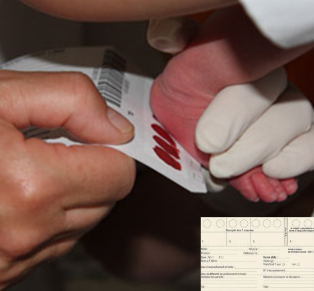 [Sickle cell disease in French Guiana: assessing 30 years of neonatal screening (1992-2021)].